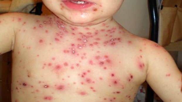  Rafila: Epidemia de rujeolă, rezultatul unei cohort de copii care nu sunt vaccinaţi