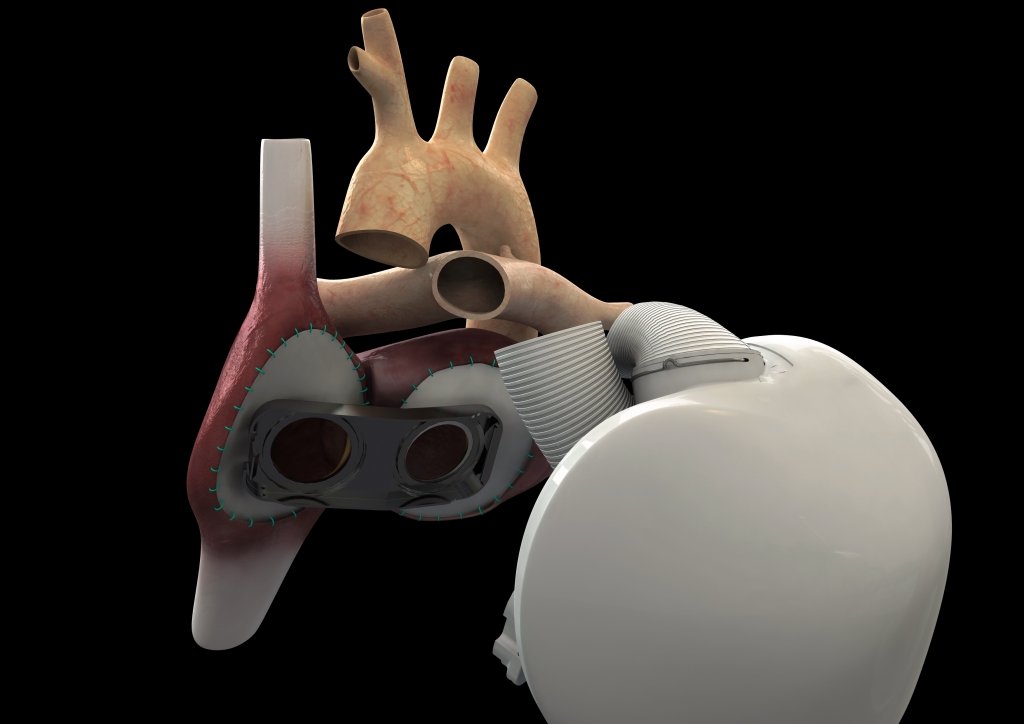  Premieră mondială în medicină: A fost implantată o inimă artificială