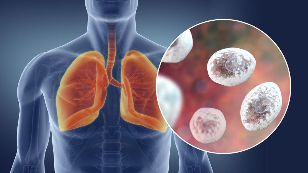  Progrese cheie în combaterea unei cauze principale a pneumoniei fungice