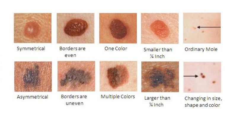  În faze incipiente melanomul cutanat se poate vindeca