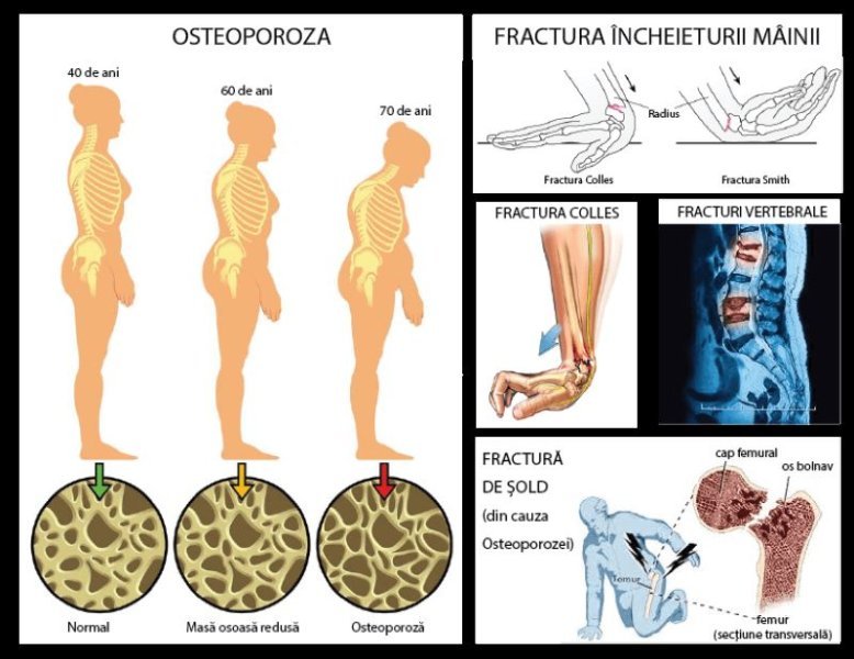  Riscul de osteoporoză și fracturi crește peste vârsta de 65 de ani