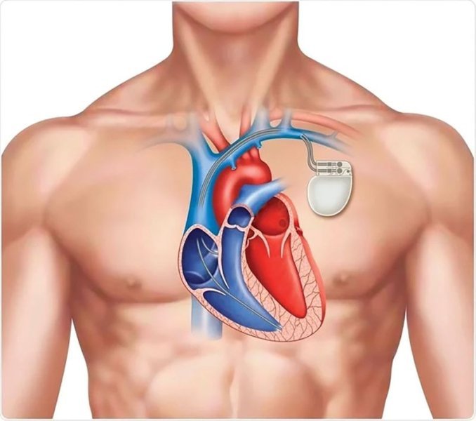  Defibrilatorul cardiac implantabil