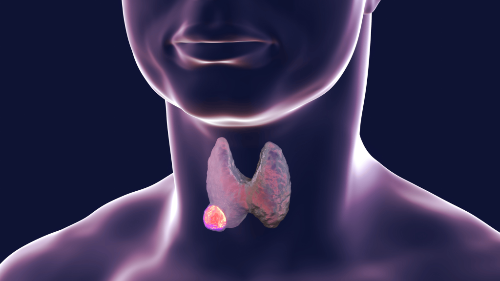  Medic: Bolile tiroidiene sunt boli frecvente la doamne