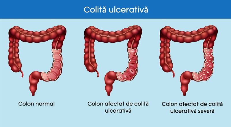  Colita ulcerativă poate fi controlată cu medicamente dar poate provoca și apariția cancerului de colon
