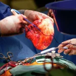 AI ar putea oferi în timp real informații vitale chirurgilor privind compatibilitatea  pentru un transplant cardiac
