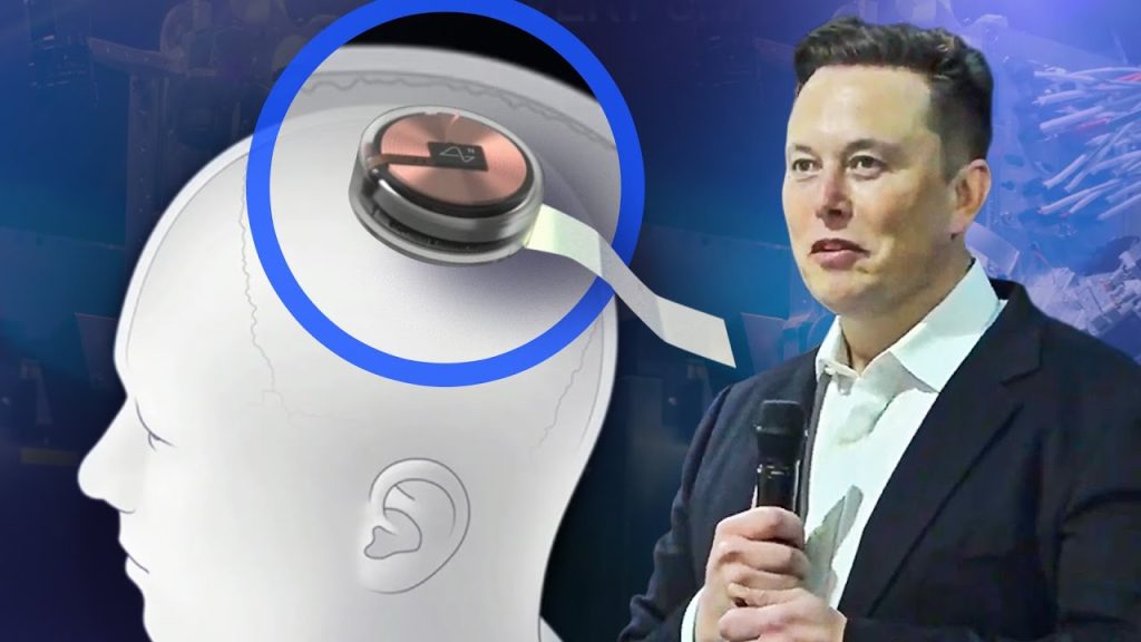 Eșec pentru Elon Musk. Primul cip Neuralink implantat a început să se desprindă de creierul pacientului